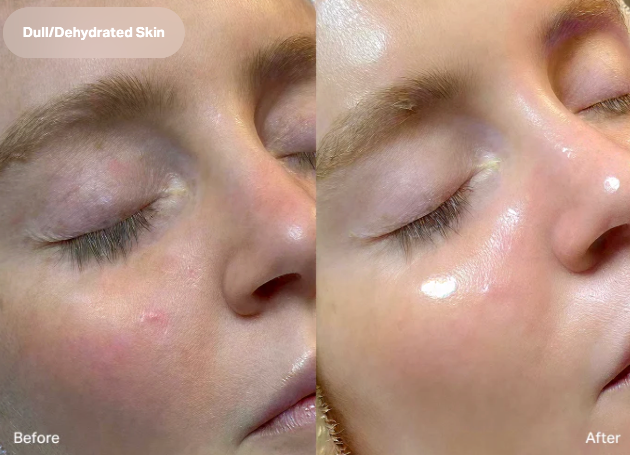 HydraFacial®