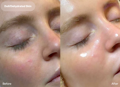 HydraFacial®